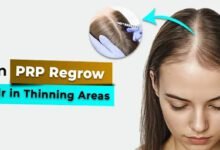 PRP regrow