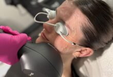 skin tightening treatment edmonton