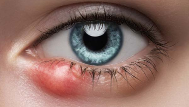 Why Bye Stye Beats Warm Compresses Alone