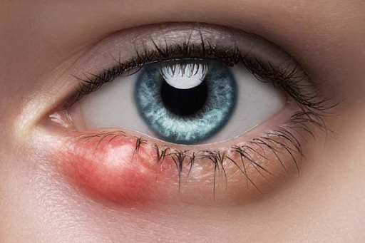 Why Bye Stye Beats Warm Compresses Alone